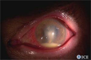 Contact Lens Infection