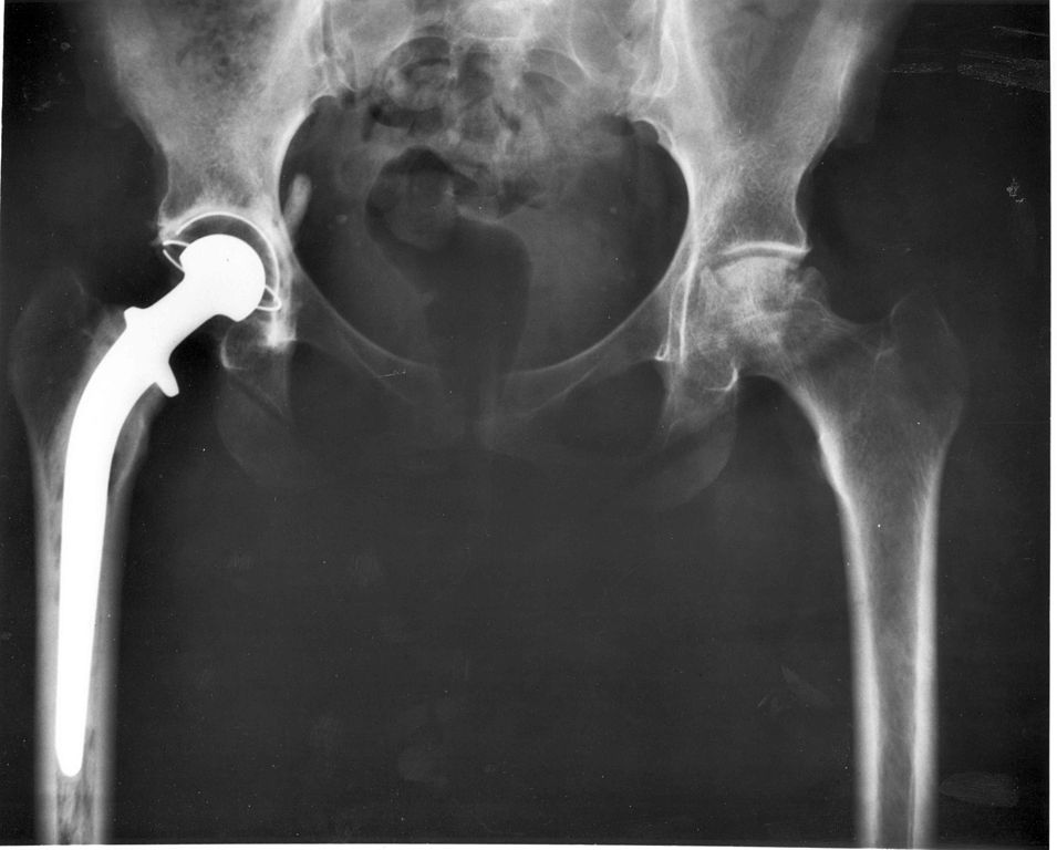Hip Implant Recall