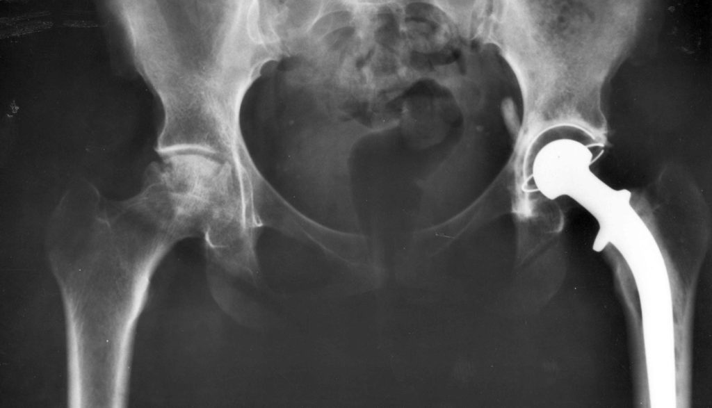 Metal on Metal Hip Implant Lawsuit Settlement