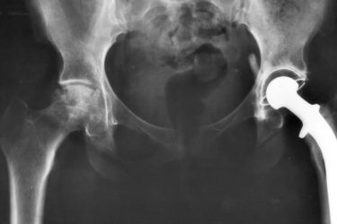 Metal on Metal Hip Implant Lawsuit Settlement