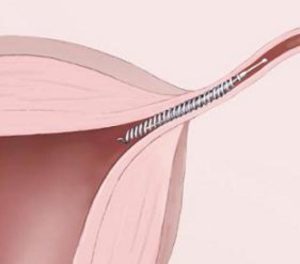 Essure Recall for Side Effects