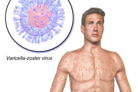 Lawsuits for Zostavax Shingles Vaccine Side Effects