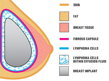 Breast Implant Lymphoma Lawsuit