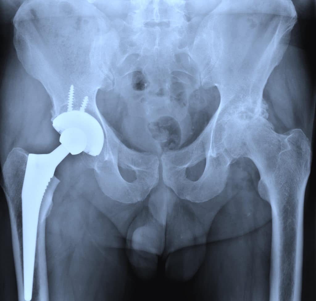 Hip Replacement Lawyer