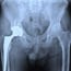 Hip Replacement Lawyer