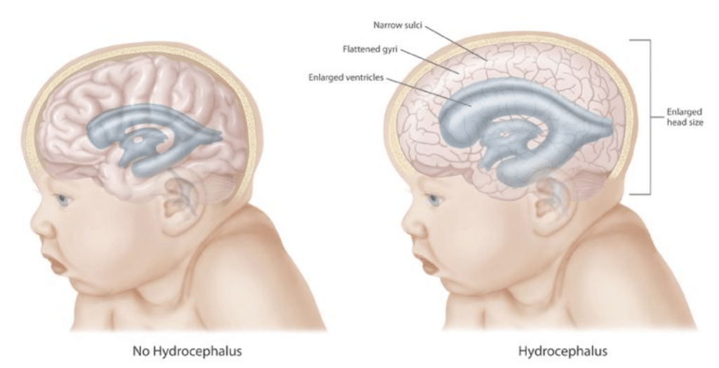 CDC Hydrocelphalus Pictures
