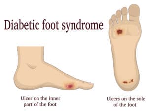Canagliflozin Diabetes Foot Amputation Ulcers
