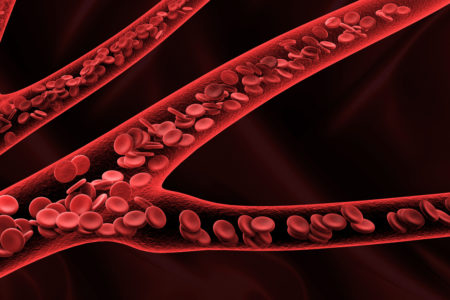 Lawsuit for IVC Filter Blood Clot Side Effects