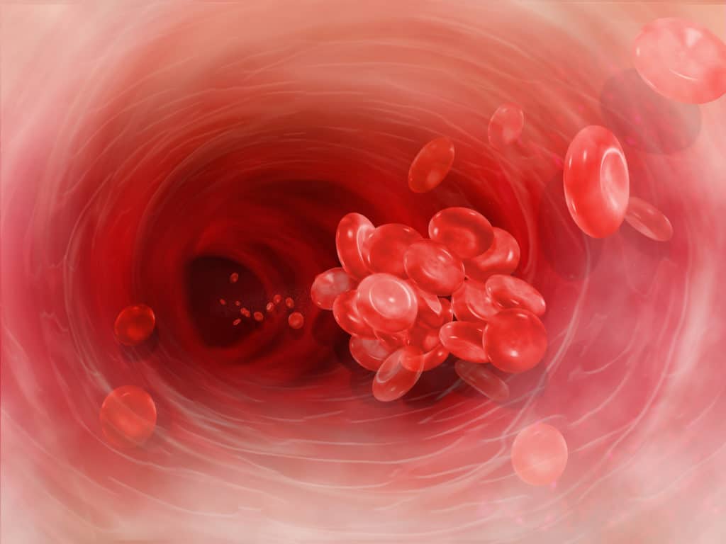 California Woman Files Blood Clot Filter Lawsuit