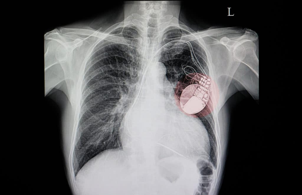 FDA Issues Class 1 Recall for Over 150K Medtronic Pacemakers