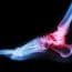 FDA Warns of High Risk of STAR Ankle Replacements Breaking