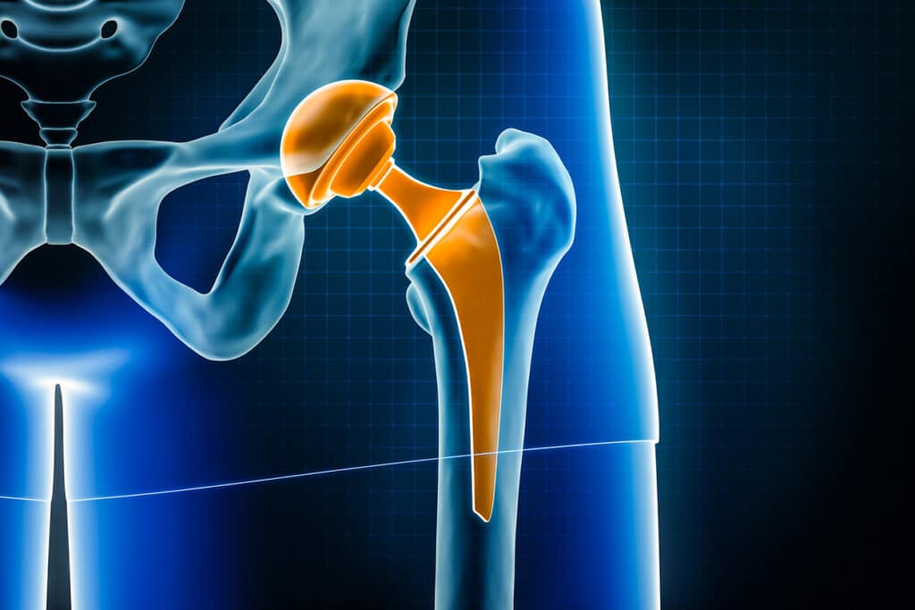 Zimmer Biomet CPT Hip System Linked to Thigh-Bone Fractures
