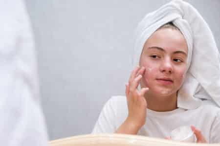 FDA Recalls 6 Acne Products for High Levels of Benzene