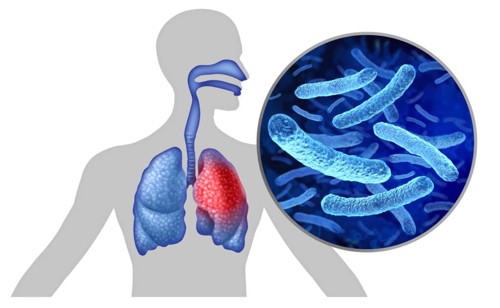 Legionnaire's Disease Outbreak